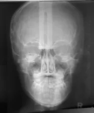 Vintage Medical X-rays Lot of 21 SKULLS Oddity 1970’s