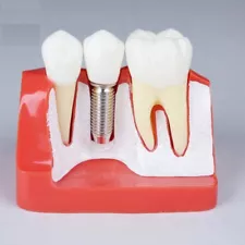 Model 2017# Sale Dental Implant Analysis for Study Teaching Teeth Tooth